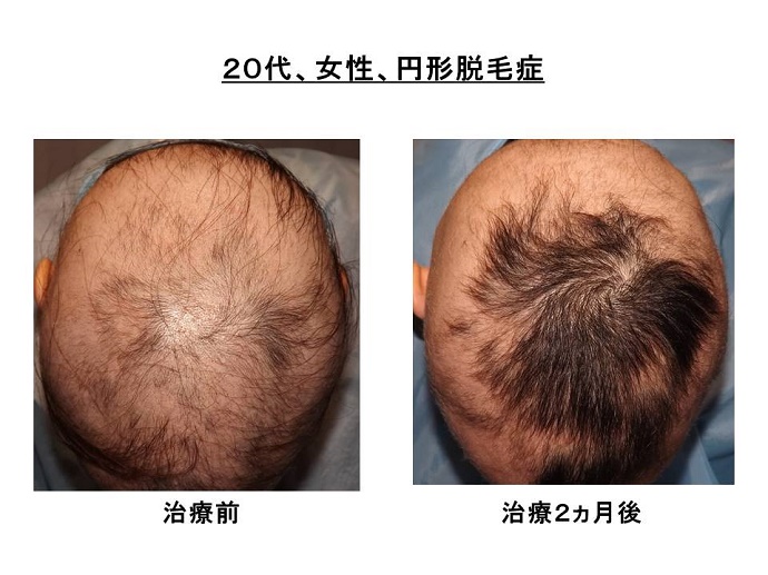 円形脱毛症　病院""